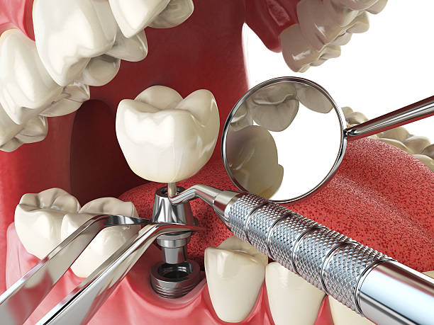 Best Emergency Tooth Extraction in Omaha, TX