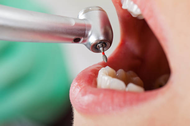 Best Emergency Treatment for Dental Infections or Abscesses in Omaha, TX